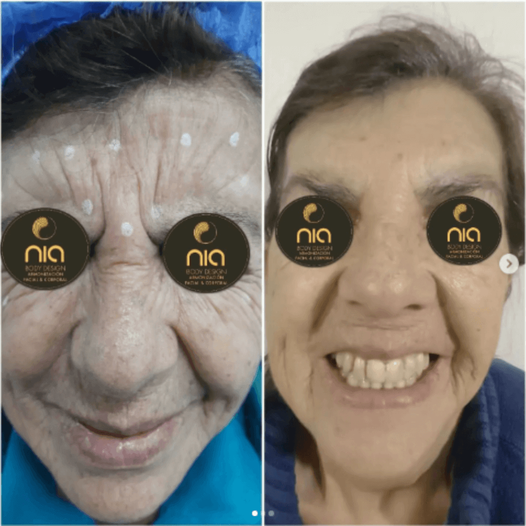Despigmentación de Piel Nia Body Design