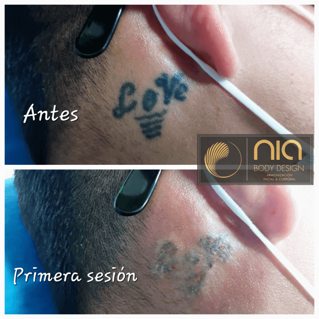 Eliminación de Tatuaje Nia Body Design