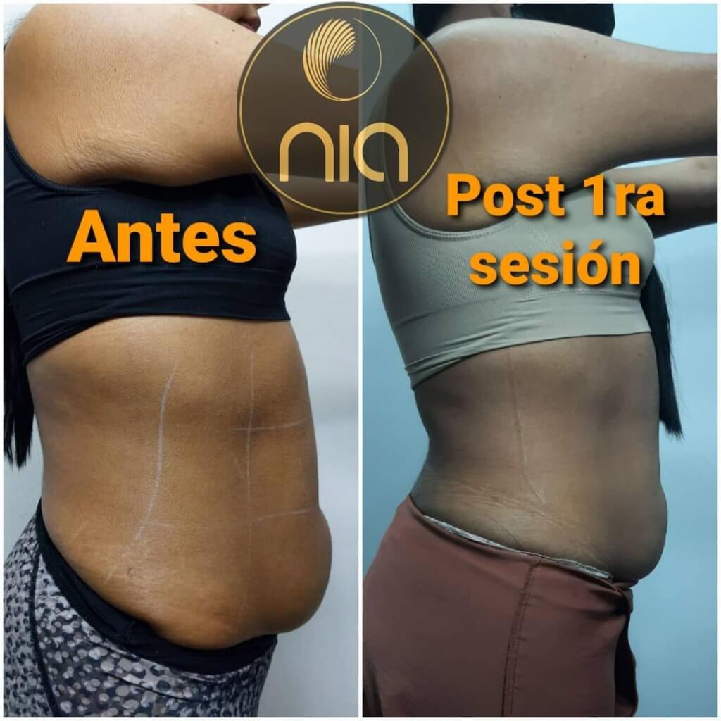 Reducción de medidas Nia