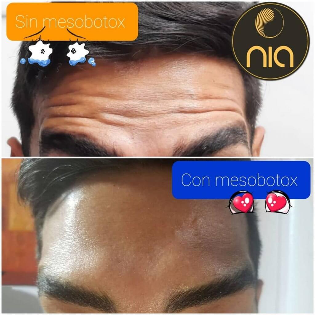 Tratamiento Botox