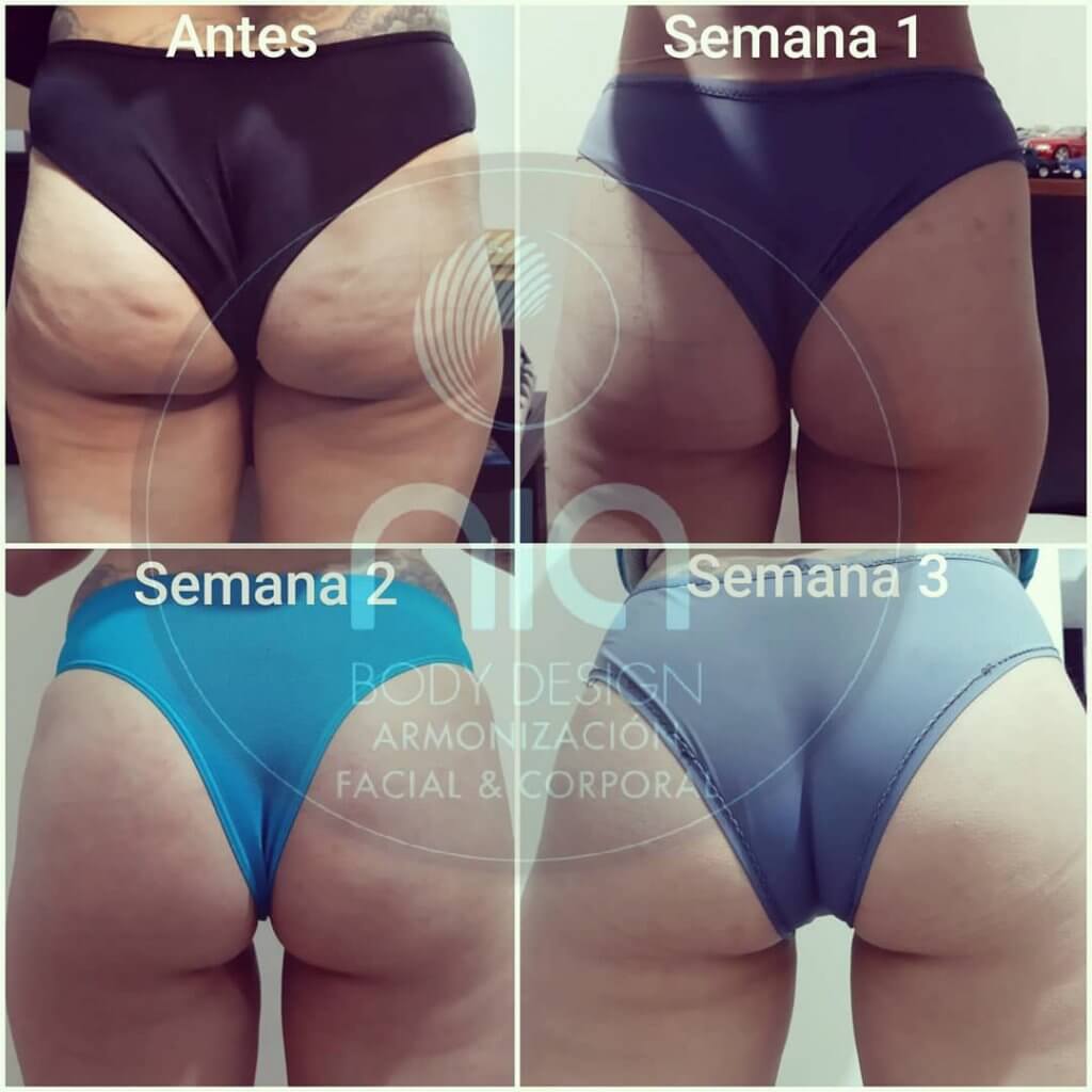 Voluminización de Gluteos y Reducción de Celulitis Nia Body