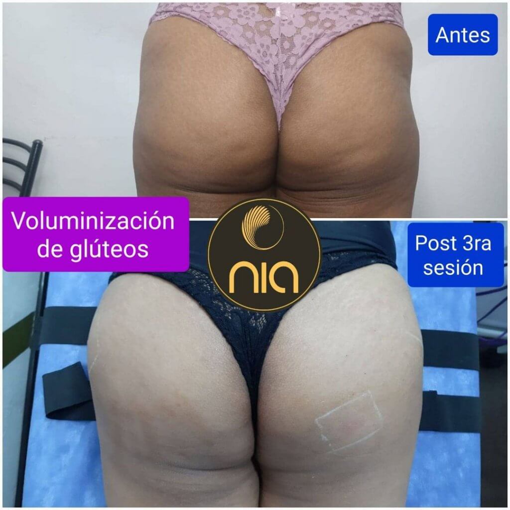 Voluminización de Gluteos y Reducción de Celulitis Nia Body Design