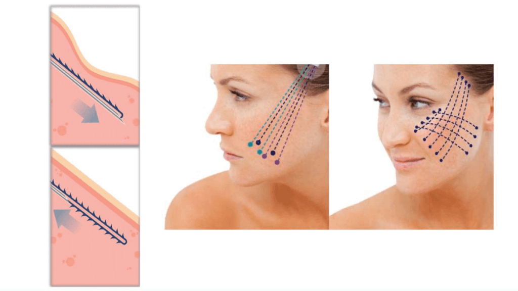 Certificación en Hilos Tensores