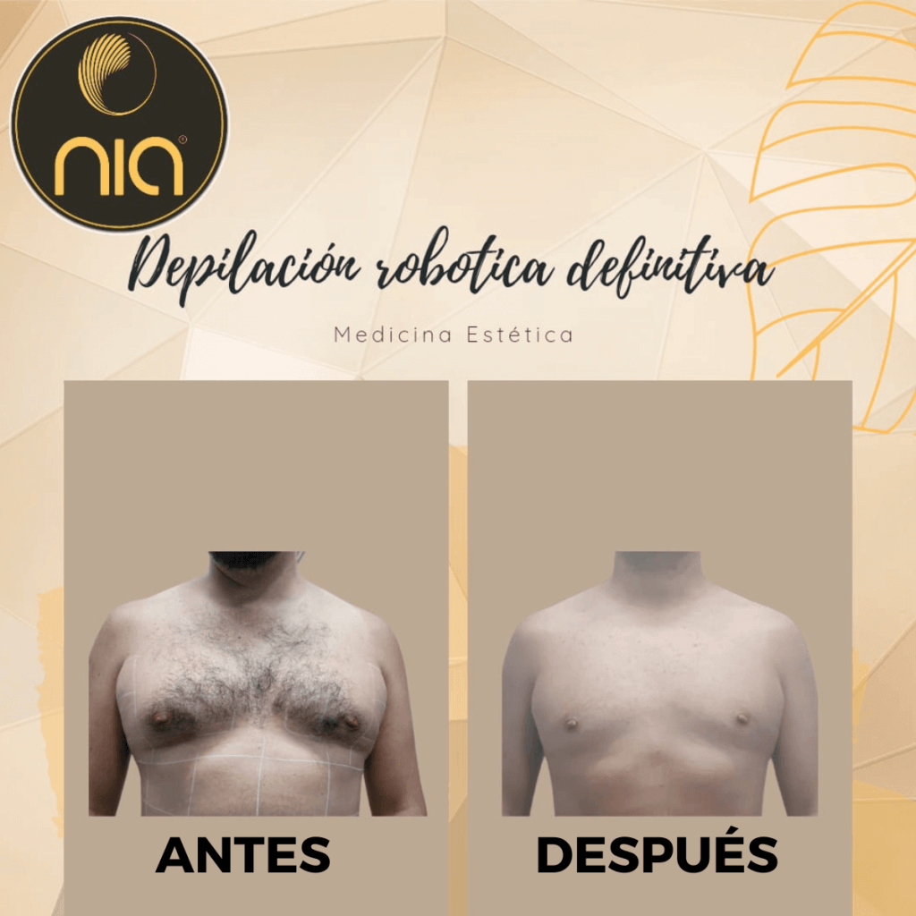 Depilación Robótica Definitiva Nia Body Design