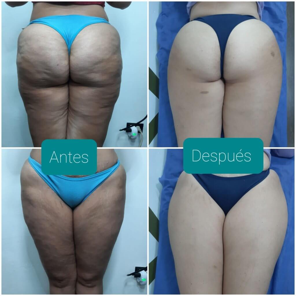 Reducción de Celulitis Nia Body Design