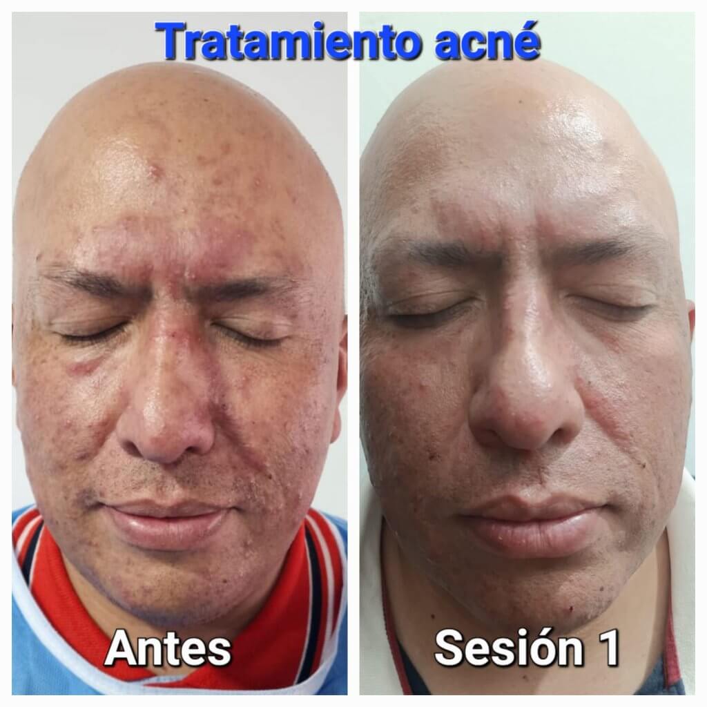 Tratamiento Anti Acné Nia Body Design