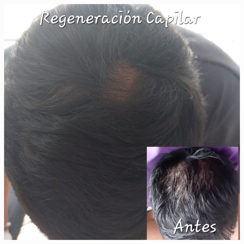 Tratamiento de Regeneración capilar Nia Body Design