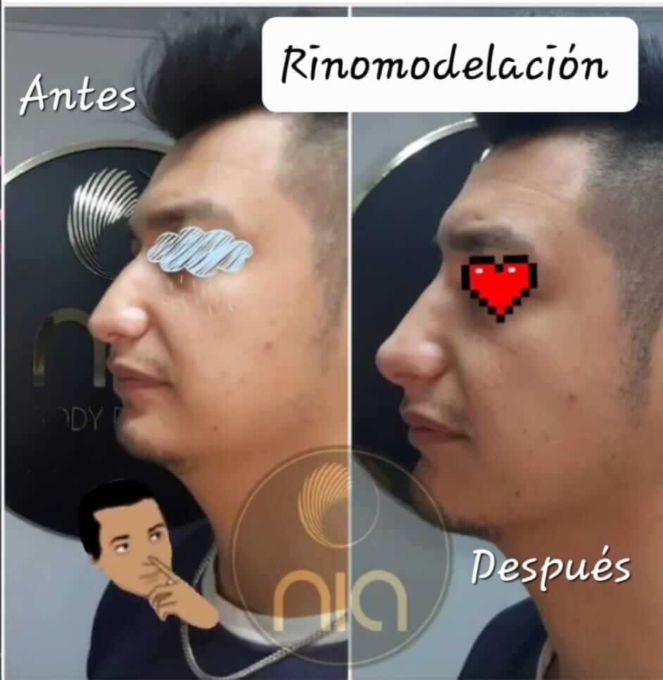Rinomodelación Nia Body Design