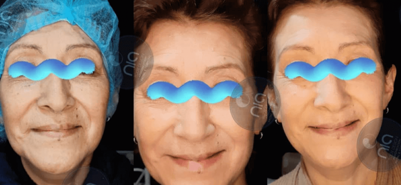 Curso de Hidratación Facial e Hilos Líquidos